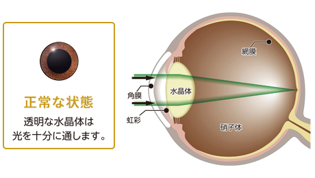 正常な状態 透明な水晶体は光を十分に通します。